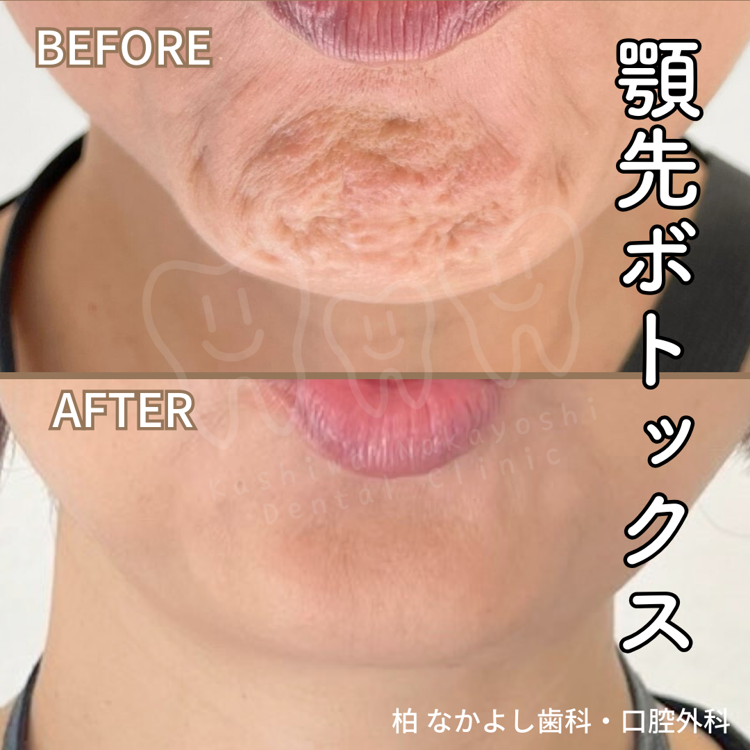 顎先ボトックス治療　症例写真